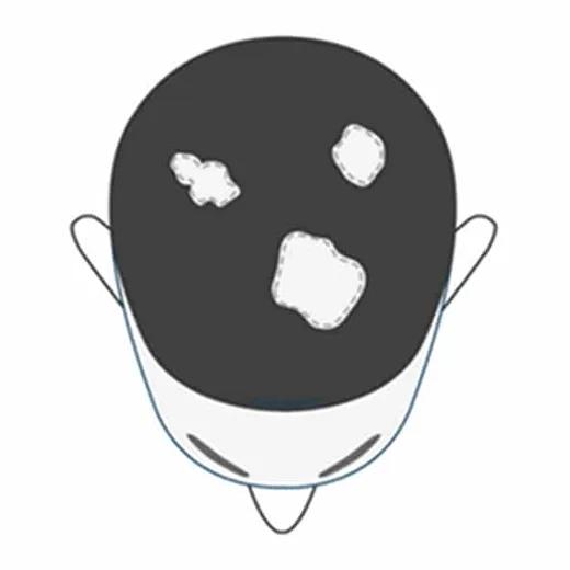 Alopecia areata