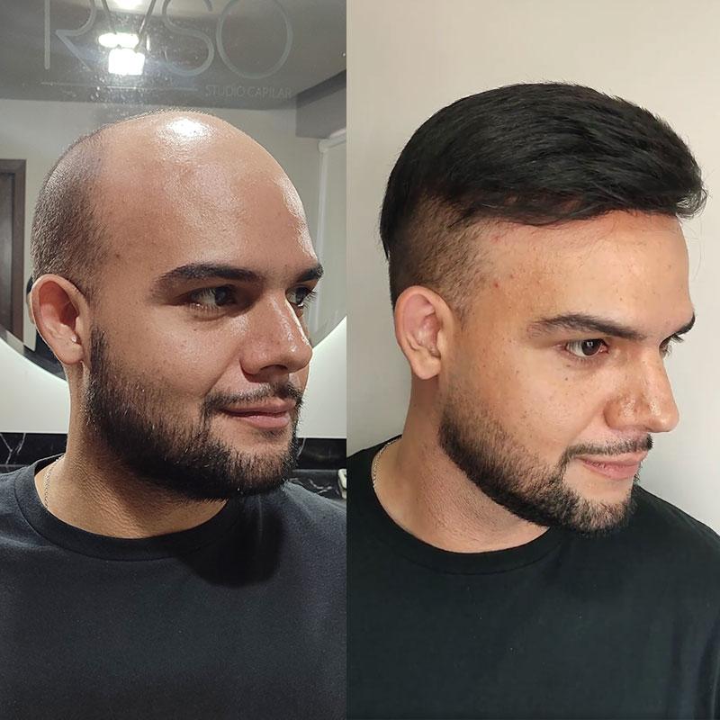 Hair System Before After Image