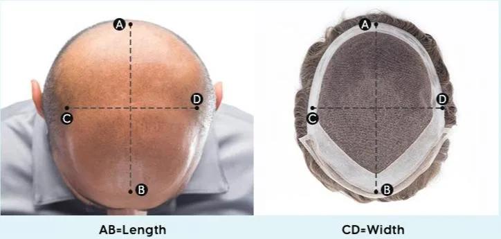 AB is the length and CD is the width measurement of the hair loss area