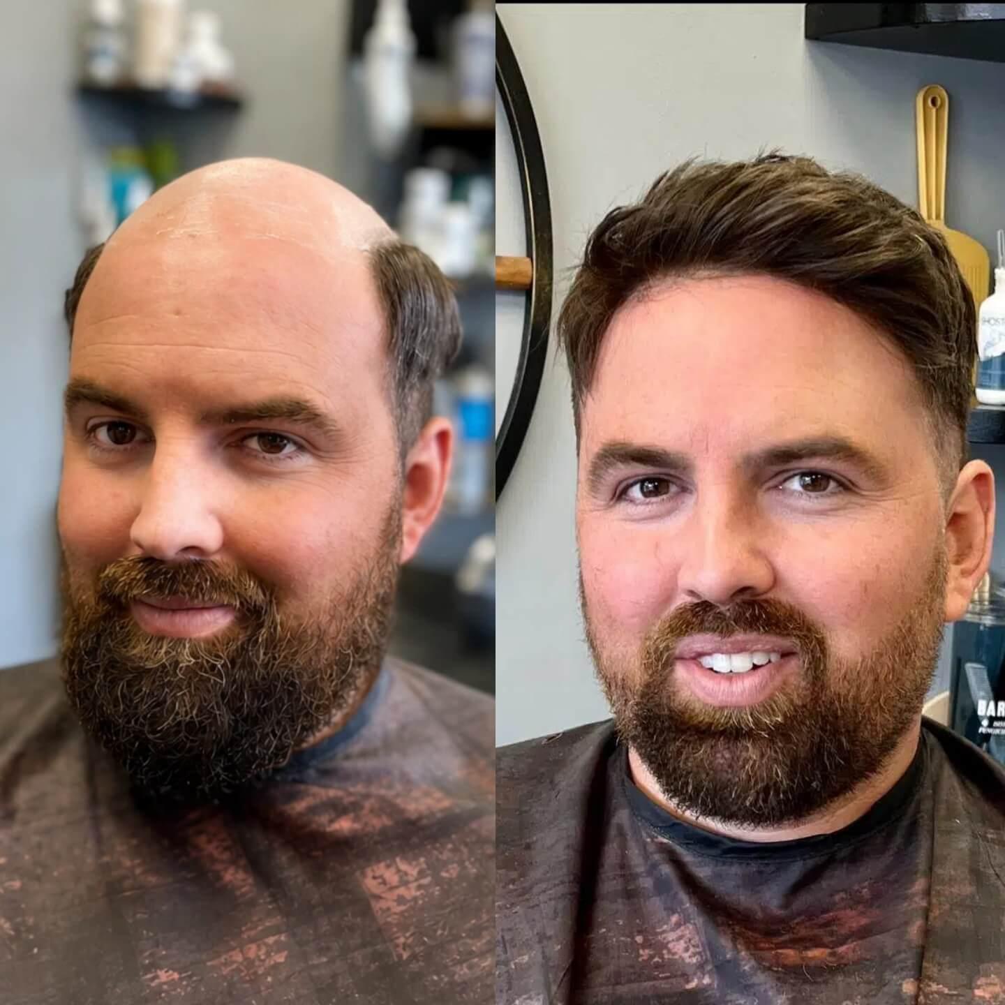 Hair System Before After Image