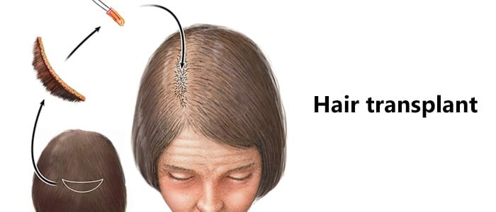 Hair Loss Causes and Solutions