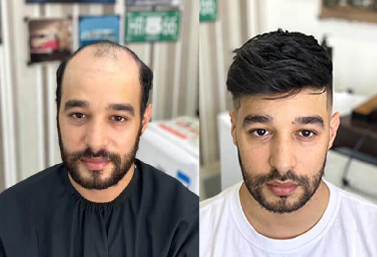 MEN-Before-after1@2x-1