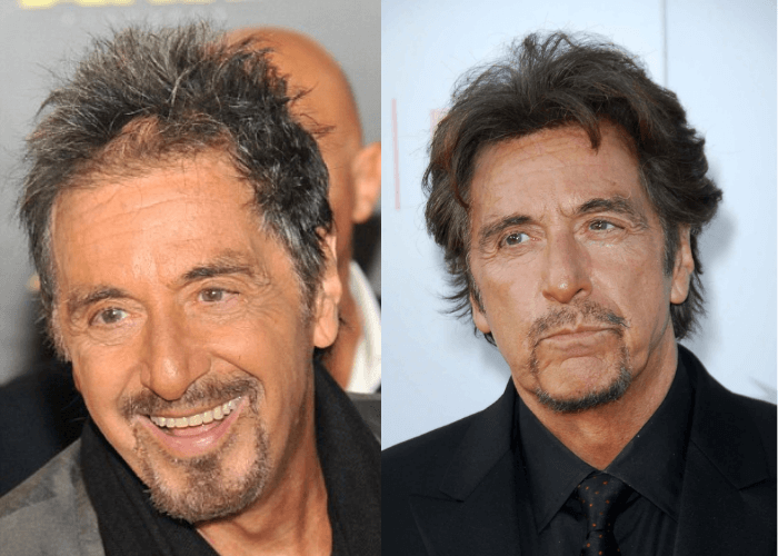 Male Celebrities Who Wear Toupees and Wigs Due to Hair Loss
