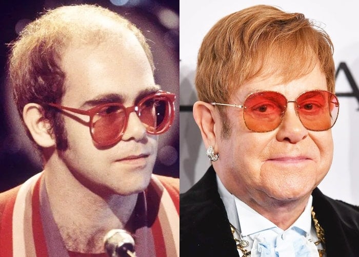 Elton-John-hair-loss