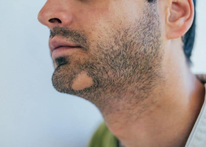 alopecia-areata-barba