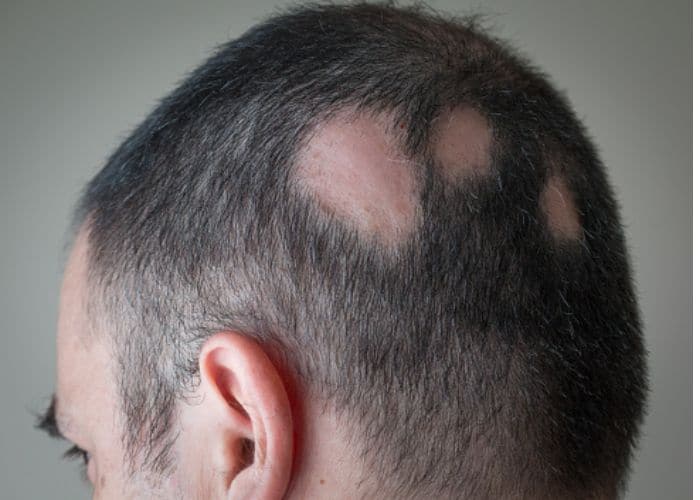 male-alopecia-areata