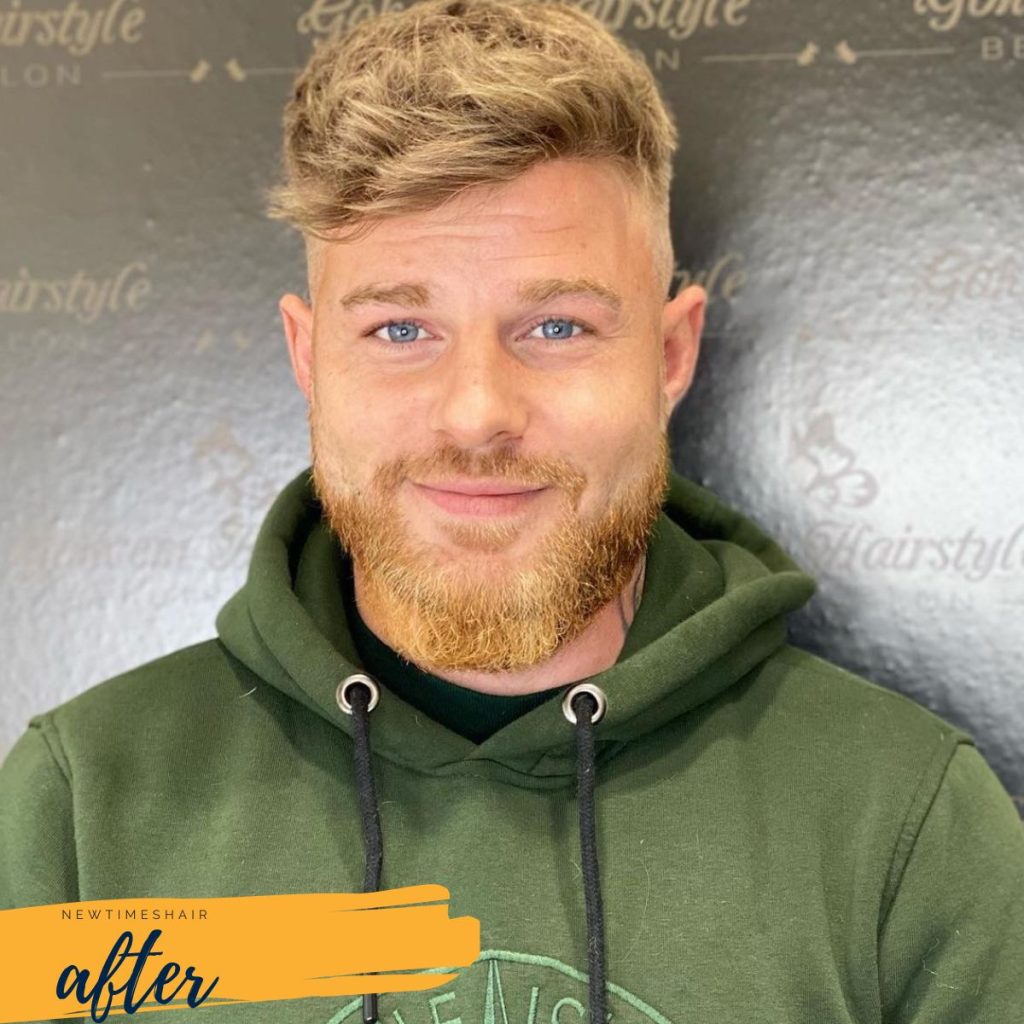 hair system before and after-after