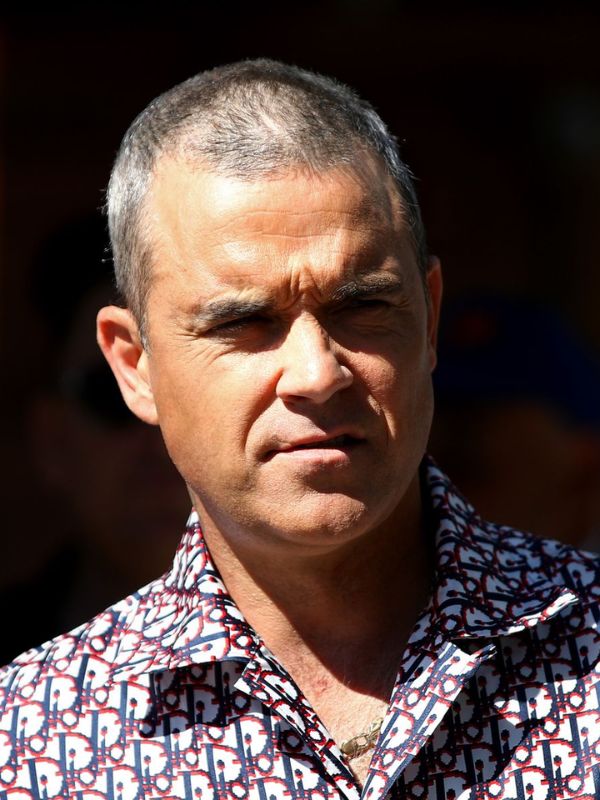 Robbie Williams hair loss
