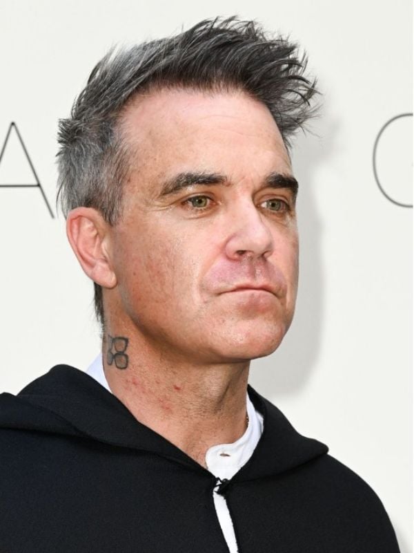 Robbie Williams hair transplant result