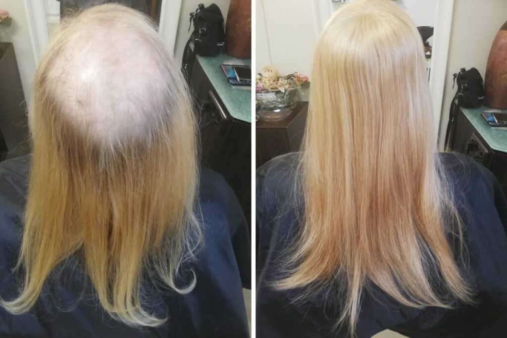 Best Hair Extensions For Balding Crowns And How To Attach