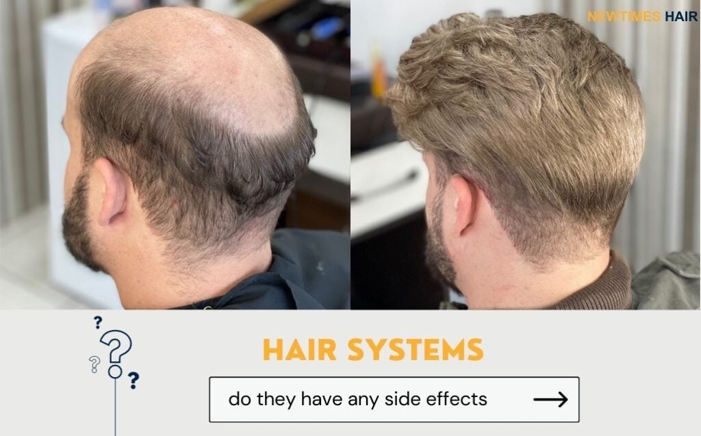HAIR SYSTEM SIDE EFFECTS