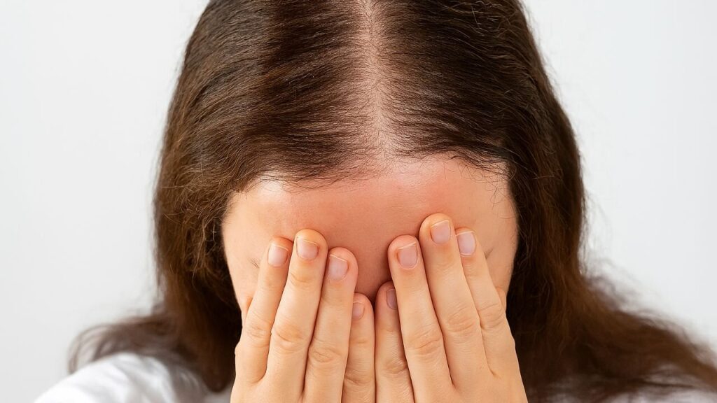 A woman in white shirt, depressed over hair loss